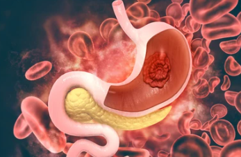 위암 4기 생존율