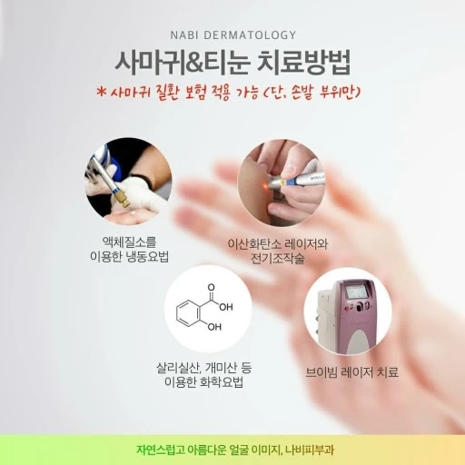 사마귀&amp;티눈 치료 방법