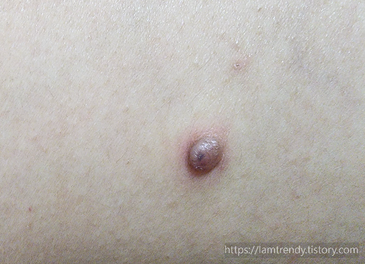 쥐젖 내동치료 당일