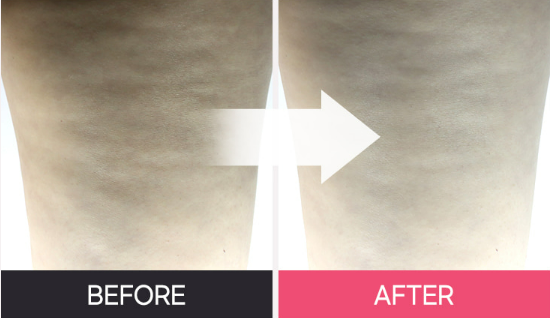 쥬비컷 지흡패치,셀룰라이트 제거 패치,지흡패치 후기,팔뚝살 빼는 법,슬리밍 랩핑 추천,바디라인 관리템