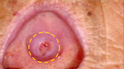 구강암 증상과 원인&amp;#44; 조기 발견이 생명을 살린다 