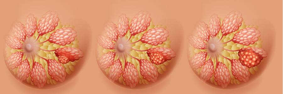 정상적인 유방의 내부 이미지와 암이 진행이 되고 있는 이미지, 그리고 암이 커져서 유방암이 된 내부 이미지를 찍은 사진