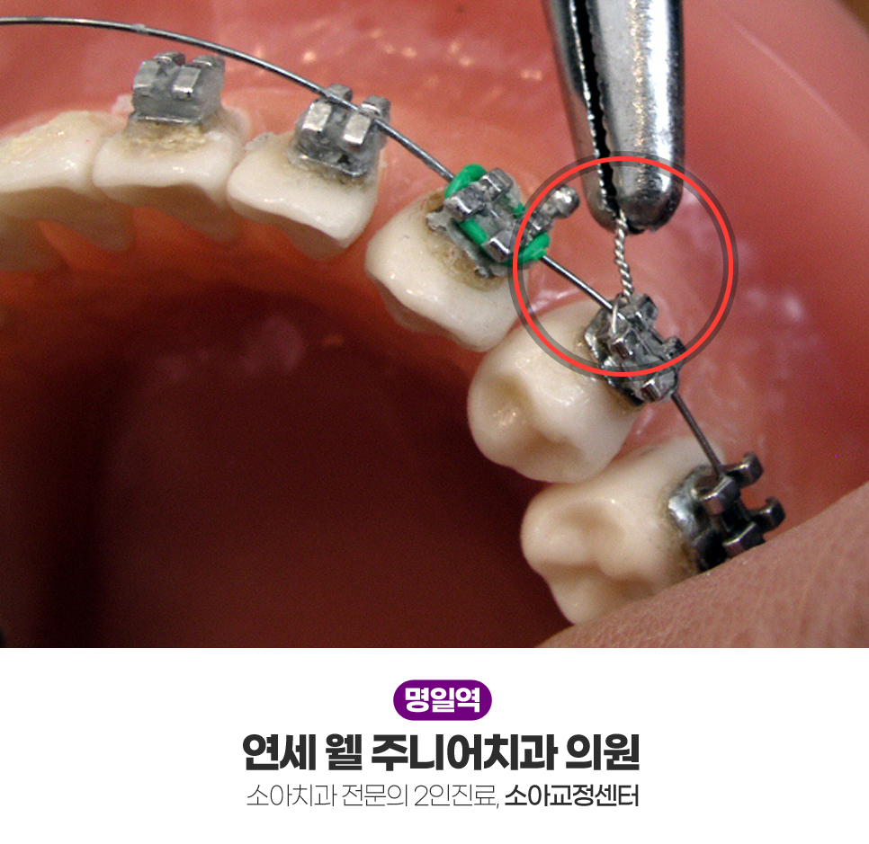 기존 브라켓 교정장치와 와이어를 이용한 치아교정 치료 모습