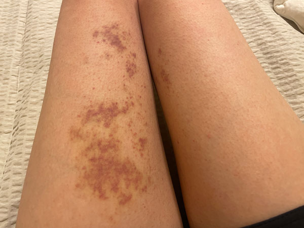 저온화상 증상 나흘째