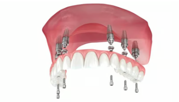 전체 임플란트 필요한 경우
