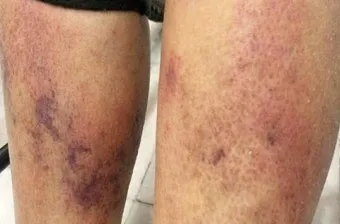 패혈증이란 무엇인지 원인 증상 치료 예방법_6