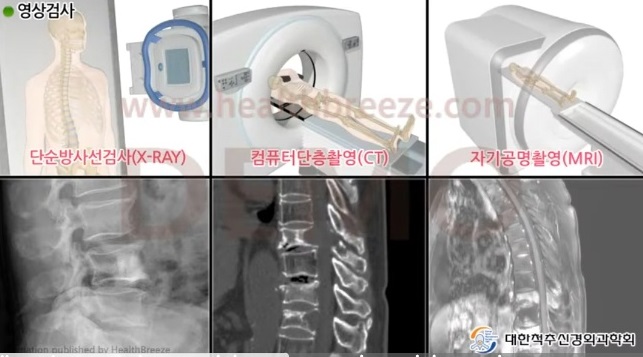 척수척추종양-명의-김치헌교수