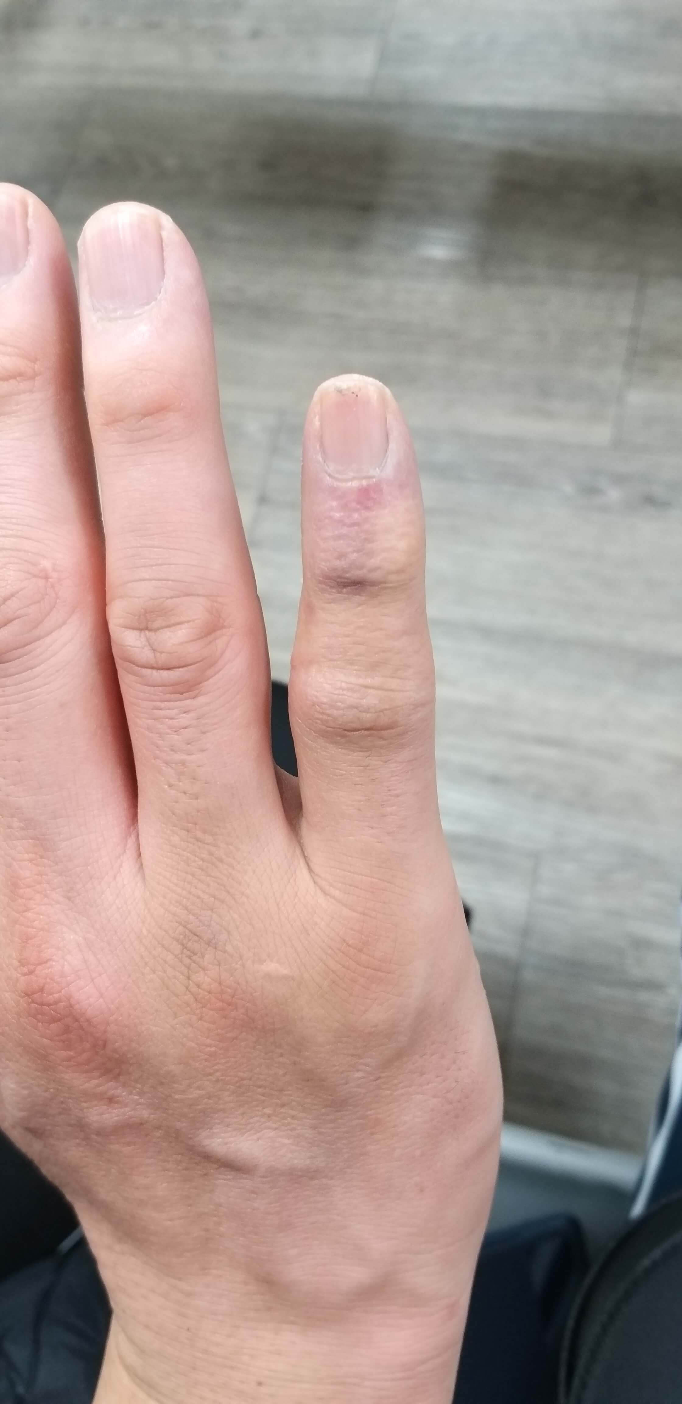 1월22일부은손가락사진2