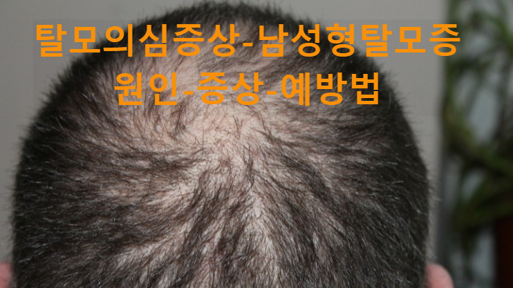 남성형탈모증