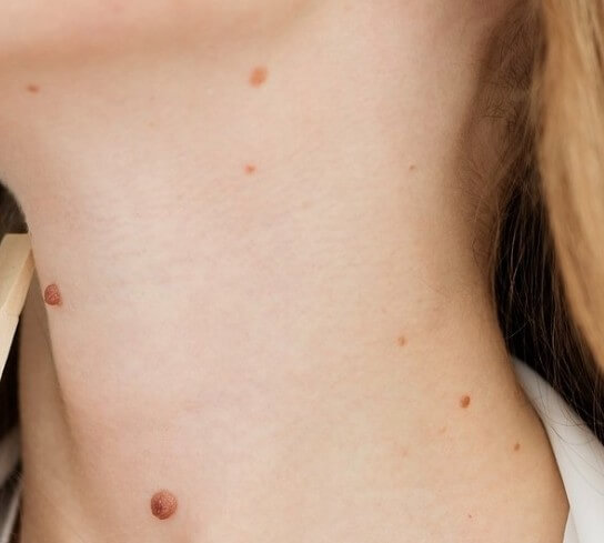 목에 있는 쥐젖