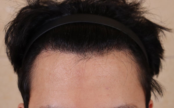 비절개 모발이식 M자 수술 후1