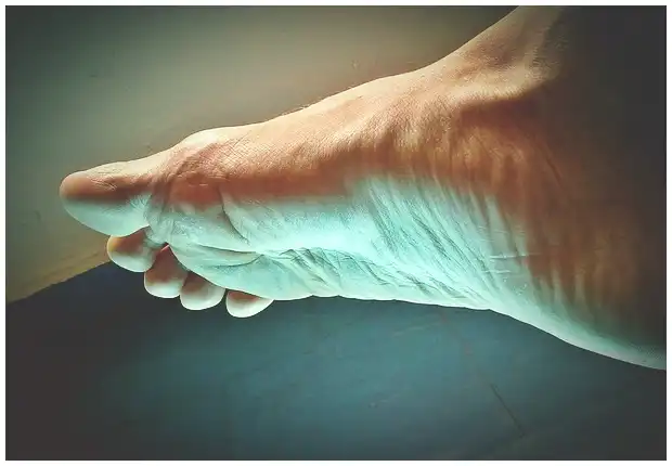 족저 근막염 치료법 (주사&amp;#44; 약&amp;#44; 걷기 중단 방법 등)