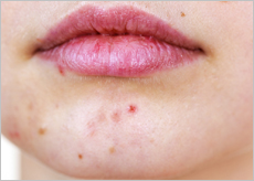 라벤다 크림 효능&amp;#44; 가격&amp;#44; 부작용&amp;#44; 무좀&amp;#44; 질염&amp;#44; 여드름