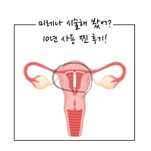 미레나 시술 후기