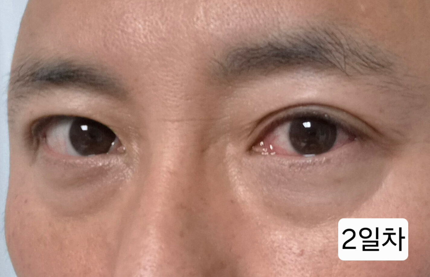 유행성각결막염 눈병 초기증상부터 12일차 치료 기록(진행 중)