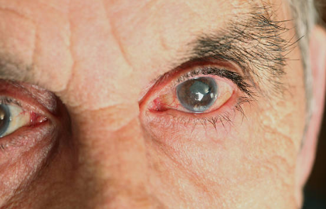 녹내장 초기증상, 실명 확률, 원인 총정리 (2024ver)