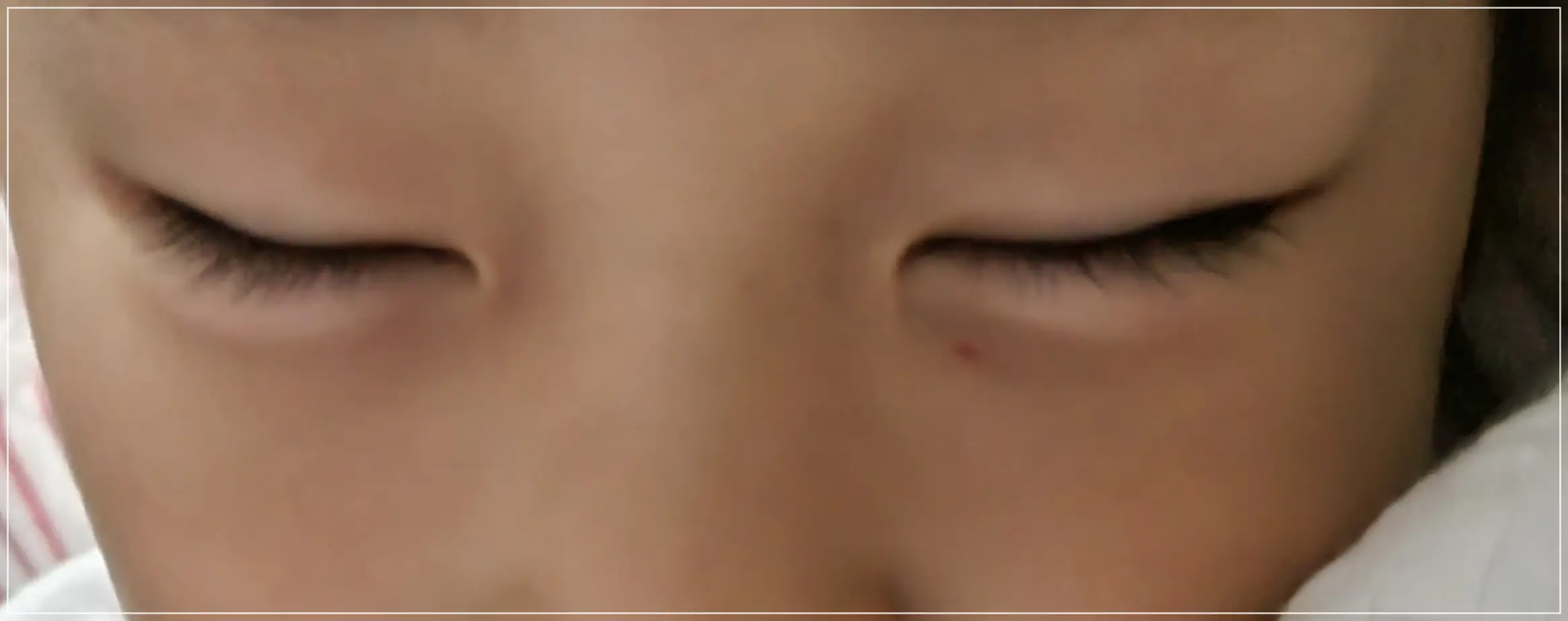 눈 두덩이 붓는 알레르기- 고등어, 이부프로펜