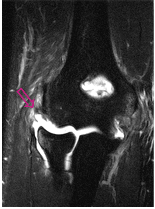 팔꿈치 관절 불안정성 사진출처 대한 정형외과 학회 홈페이지