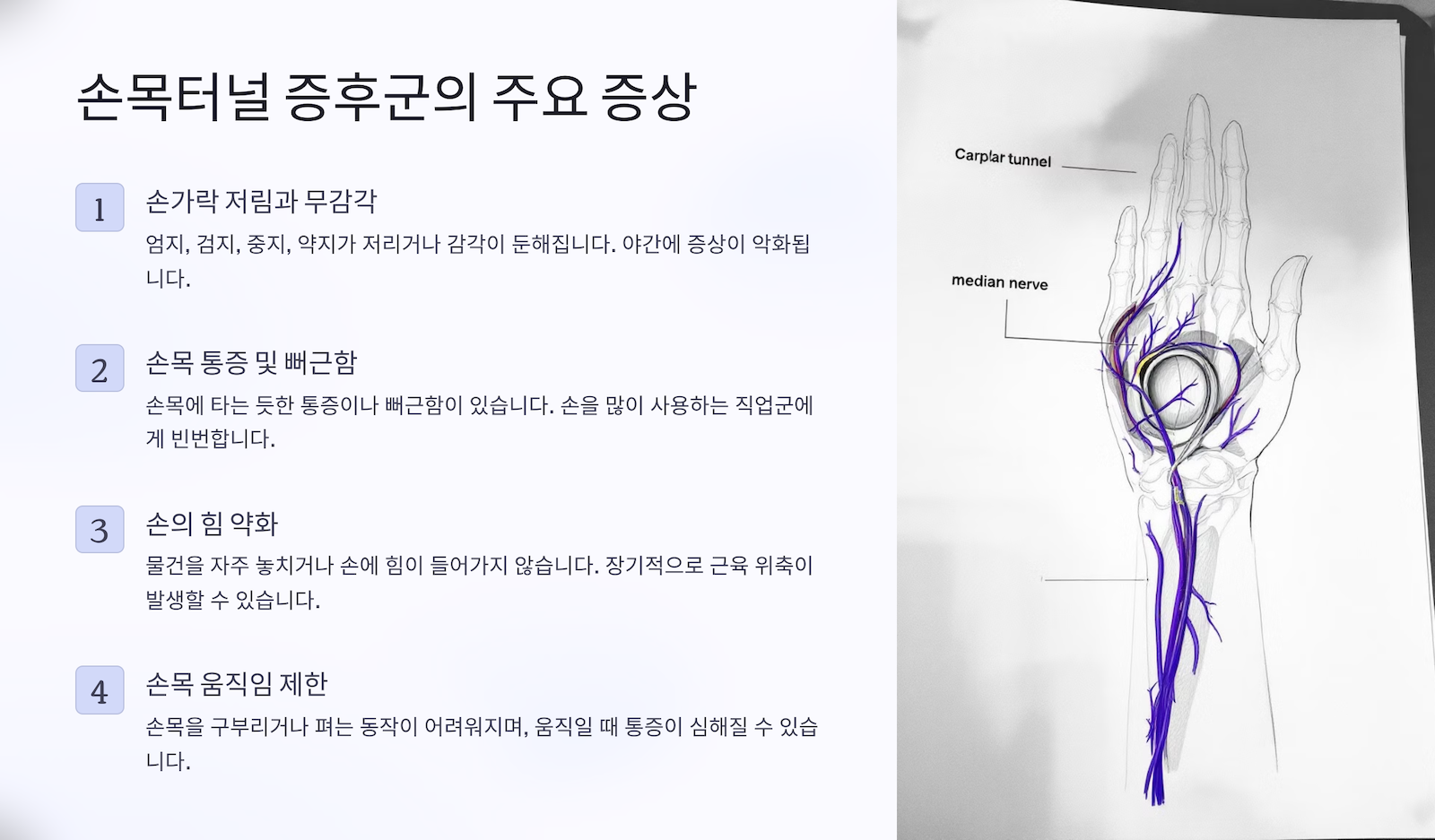 손목터널 증후군의 주요 증상