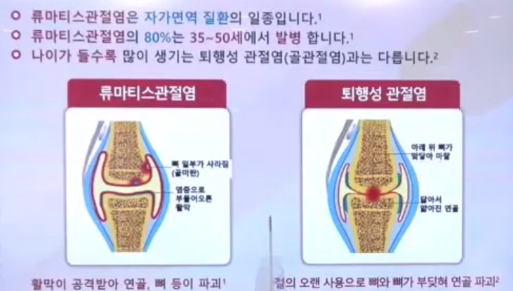 류마티스관절염과 퇴행성관절염의 차이 비교