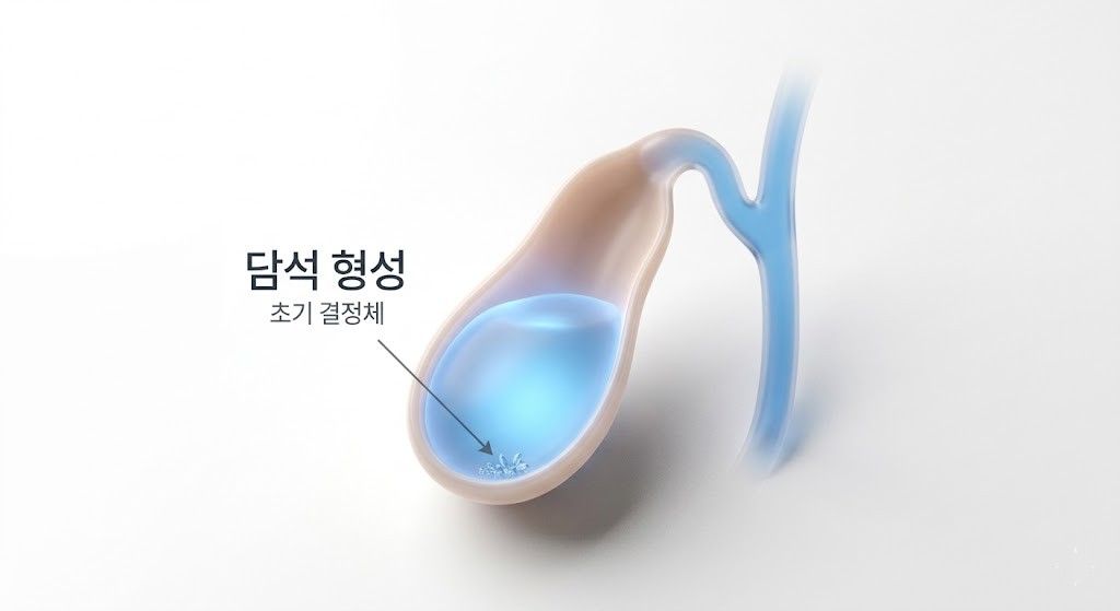 공복 시간이 길어질 때 담즙 농축으로 인한 담석증 위험 설명 이미지