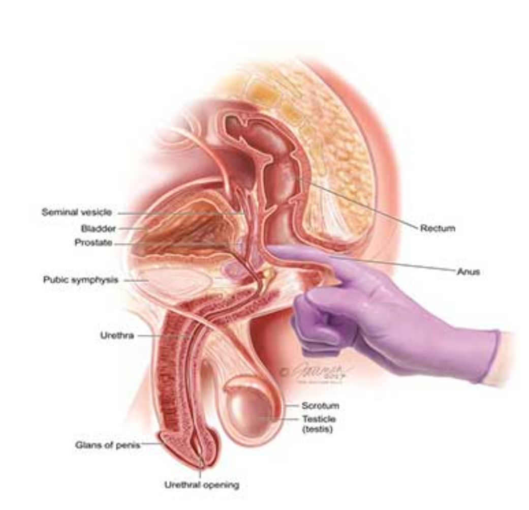 전립선암 증가와 조기 진단 필요성 관련 이미지