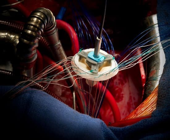 심장 판막 치환술(Heart Valve Replacement Surgery): 절차, 목적 및 회복 과정