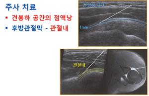 어깨가 아파요