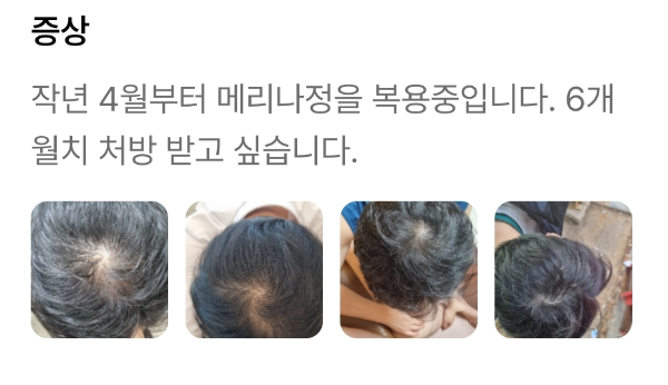 탈모약 먹기 전 후 머리 모습