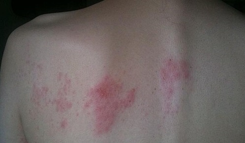 글의 이해를 돕기 위한 대상포진