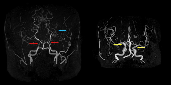 고지혈증 초기증상&amp;#44; 특별한 통증이 없는데 위험한 이유