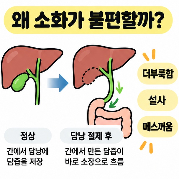 담낭 제거 뒤 담즙이 소장으로 흐르는 변화와 더부룩함, 설사, 메스꺼움을 간단히 보여주는 카드