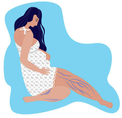 하지정맥류 증상 수술비용 좋은운동 등 총정리(2024 최신)