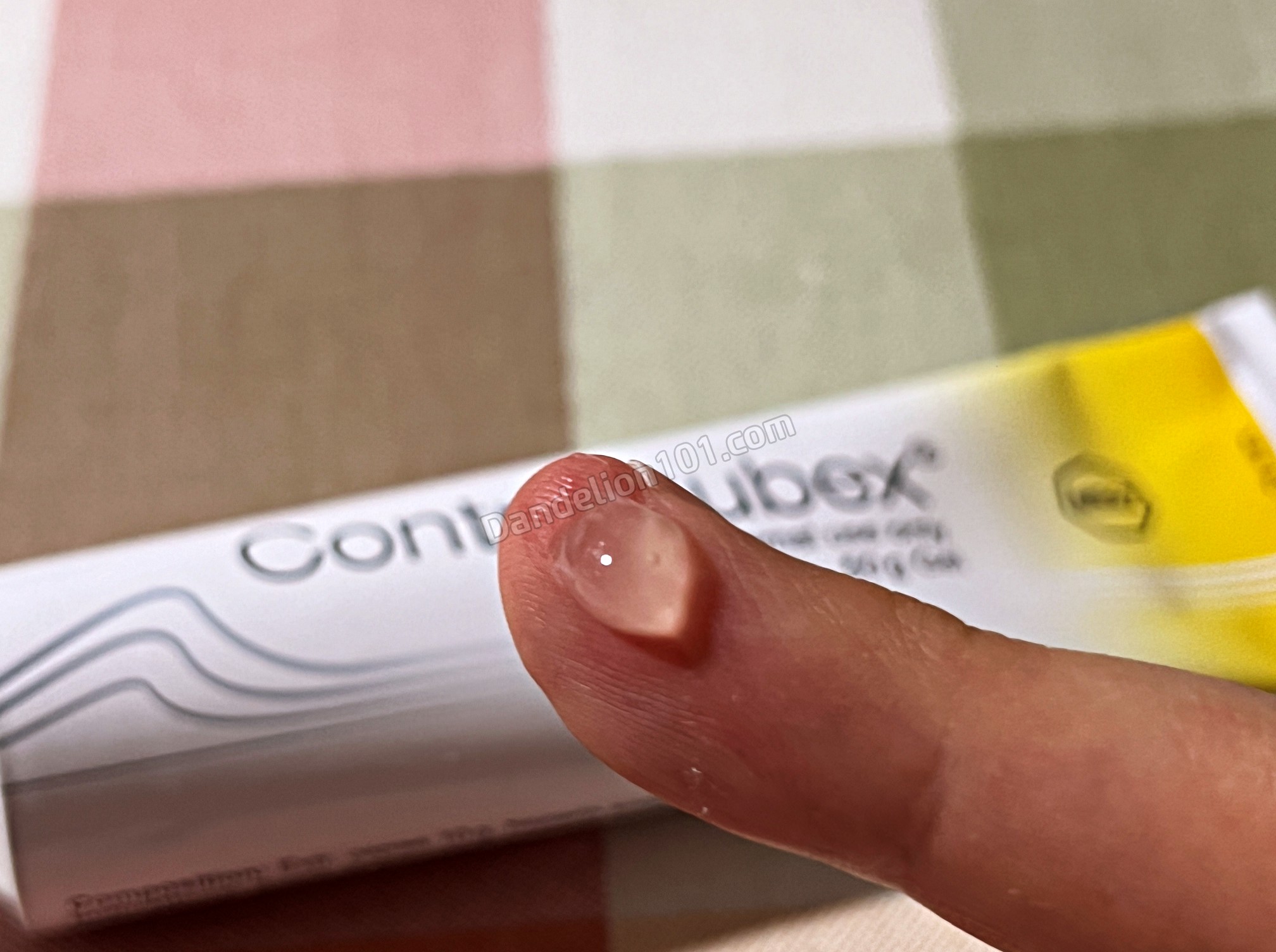 콘투락투벡스(Contractubex) 연고를 손가락 흉터에 바른 사진