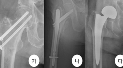 고관절 이미지