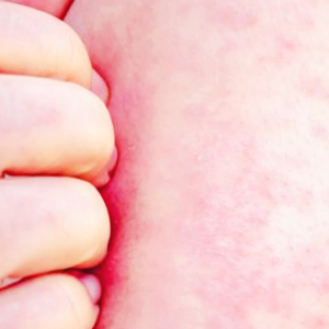 홍역 관련주 대장주 테마주 수혜주 TOP5