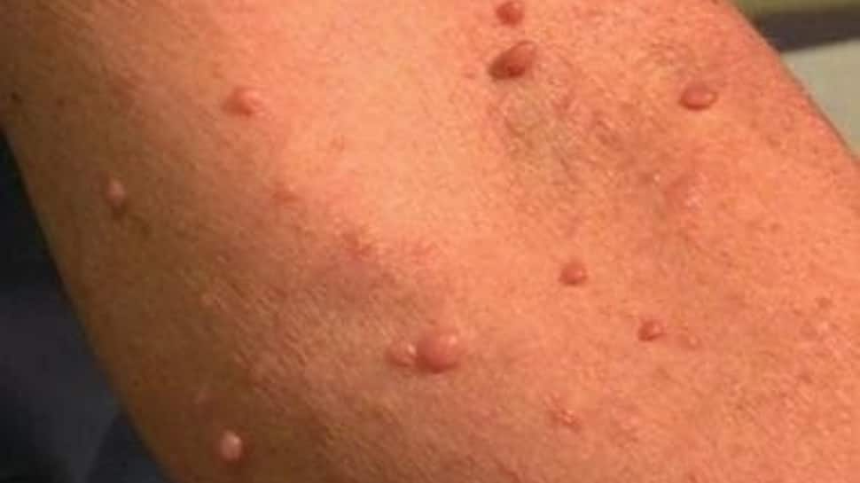 신경섬유종 초기 증상, 혹시 나도? 놓치면 안 되는 신호