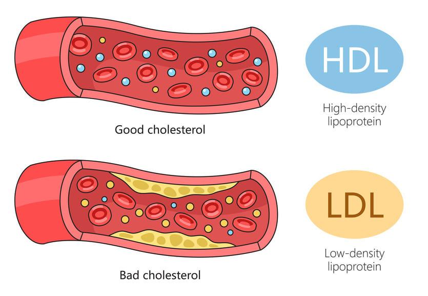 HDL과 LDL 비교 이미지 사진
