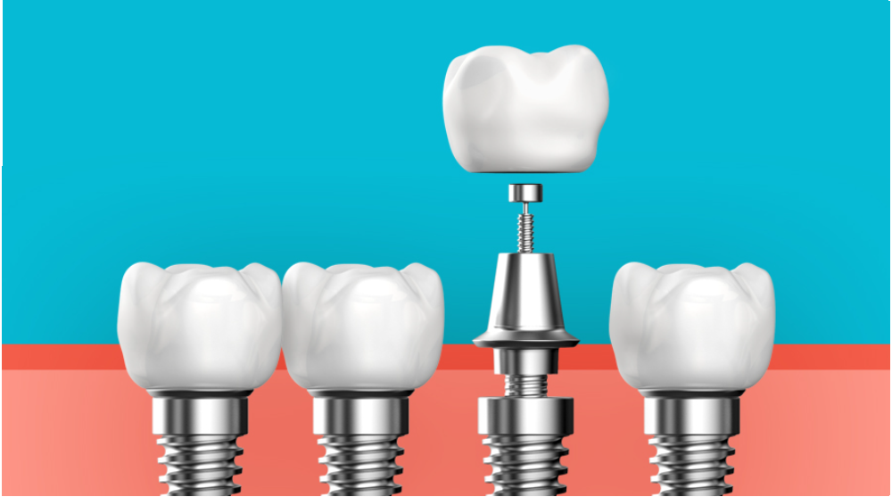 임플란트 부작용