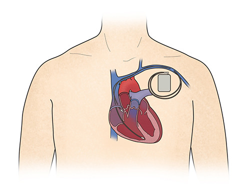 대동맥판막 협착증