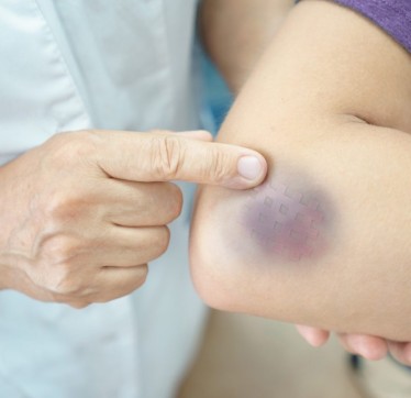 멍들었을 때 치료법 - 바르는 약 / 연고 파스 계란 사용법, 찜질, 병원