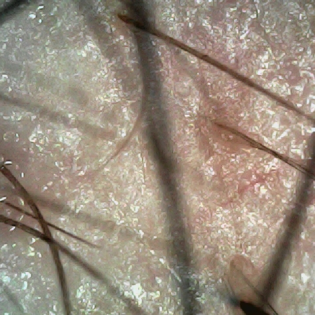 탈모 극복 프로젝트 - 오른쪽 M자 부위 두피 모습이다.