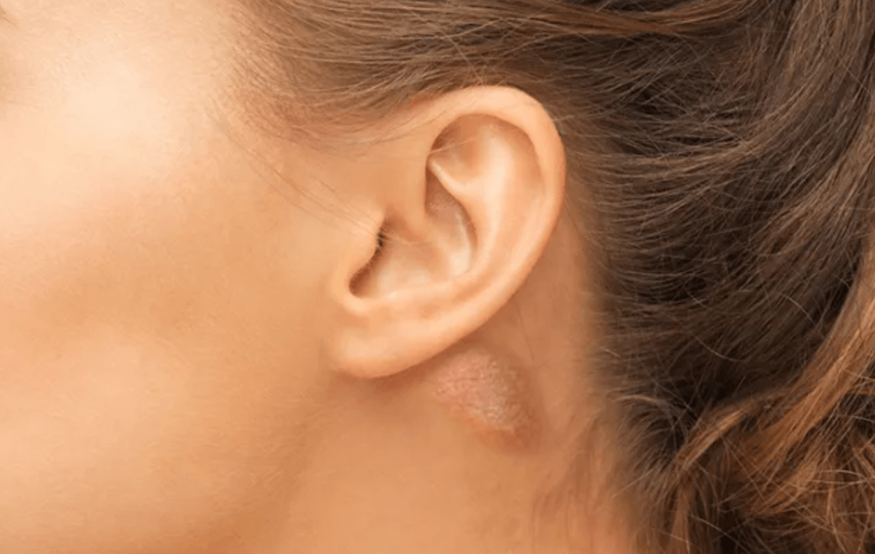 귀뒤 멍울 대처