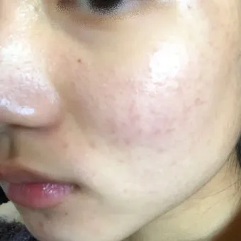 생리 전 뾰루지 폭발 원인과 해결법 7가지 생리 전후 뾰루지 발생 이유 완벽 분석_11