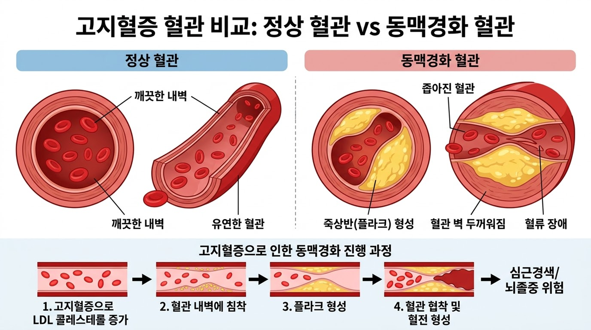 고지혈증 관리 생활수칙