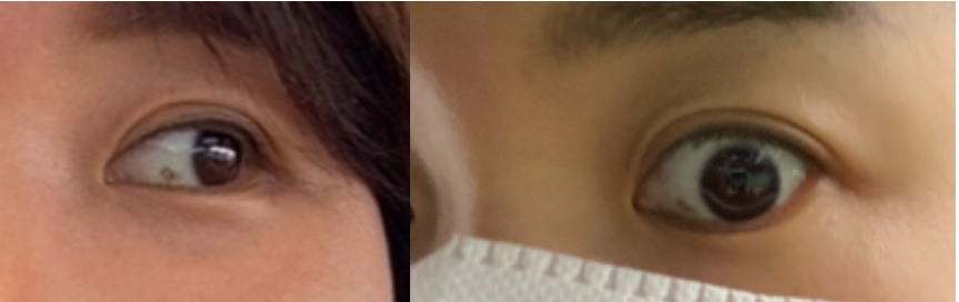 결막모반이 보이는 눈동자