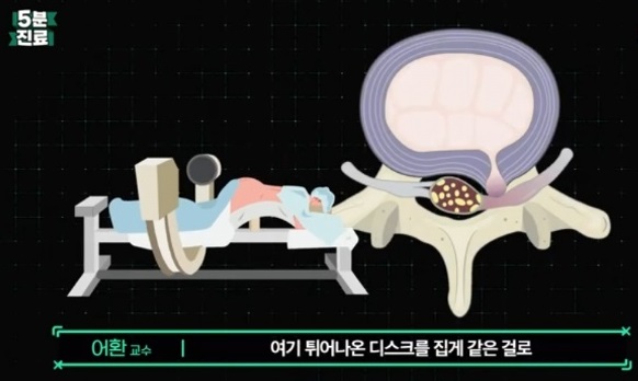 어환교수-척추명의-미세현미경-추간판절제술