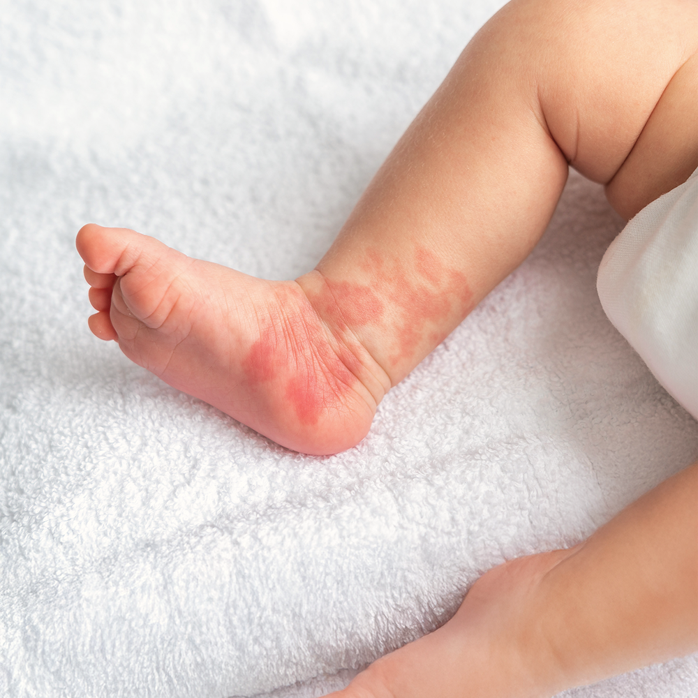 아토피, 단순 피부 트러블이라고 생각하셨나요?