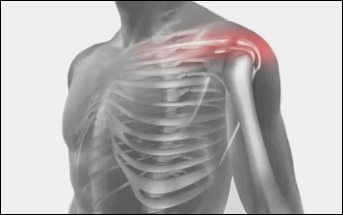 어깨통증 원인 6