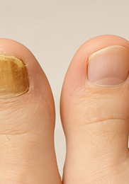 발톱무좀 없애는 방법